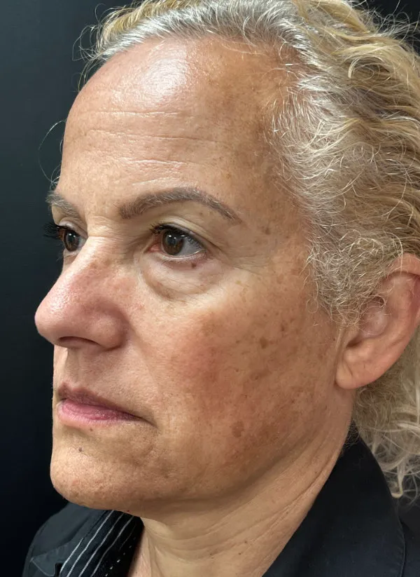 Laser Skin Resurfacing before — Laser Resurfacing, view 2