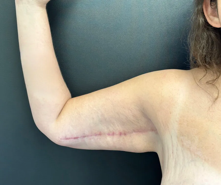Arm Lift after — Arm Lift, view 2