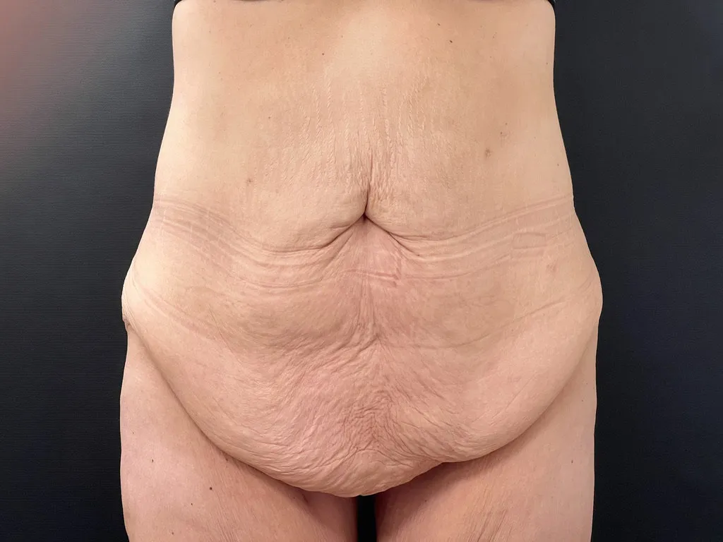Surgery After Weight Loss before — Surgery After Weight Loss, view 1