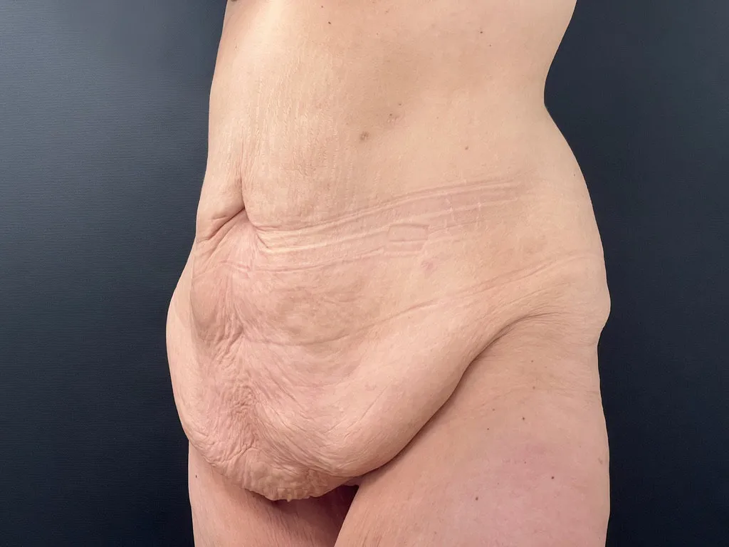 Surgery After Weight Loss before — Surgery After Weight Loss, view 2