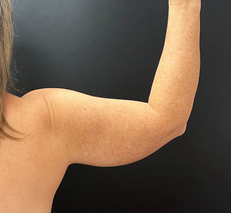Arm Lift before — Arm Lift, view 2