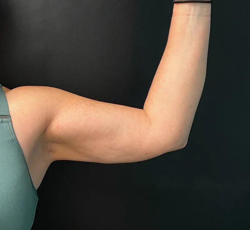 Arm Lift after — Arm Lift, view 1