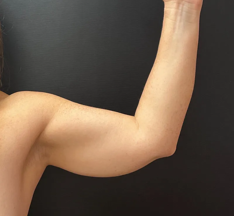 Arm Lift before — Arm Lift, view 1