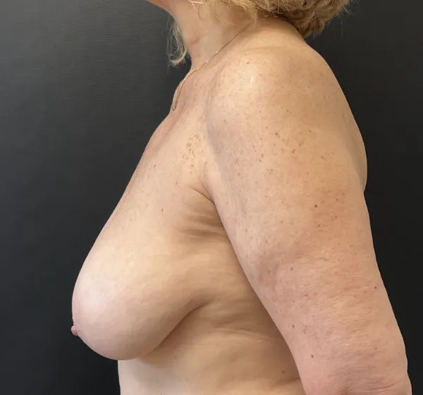 Breast Lift before — Breast Lift, view 3