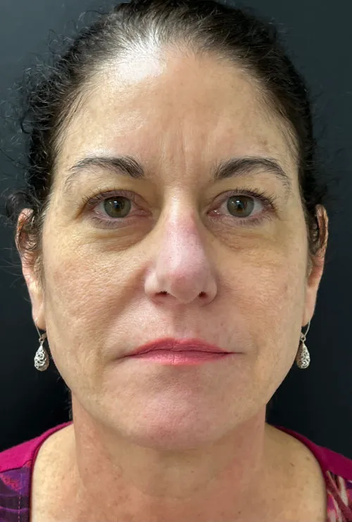 Laser Skin Resurfacing before — Laser Resurfacing, view 1