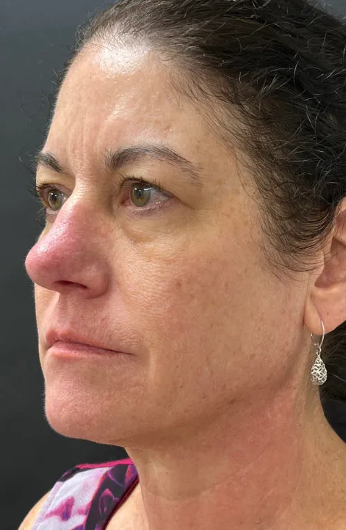 Laser Skin Resurfacing before — Laser Resurfacing, view 2