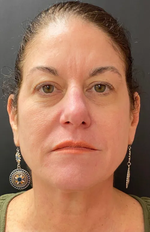 Laser Skin Resurfacing after — Laser Resurfacing, view 1