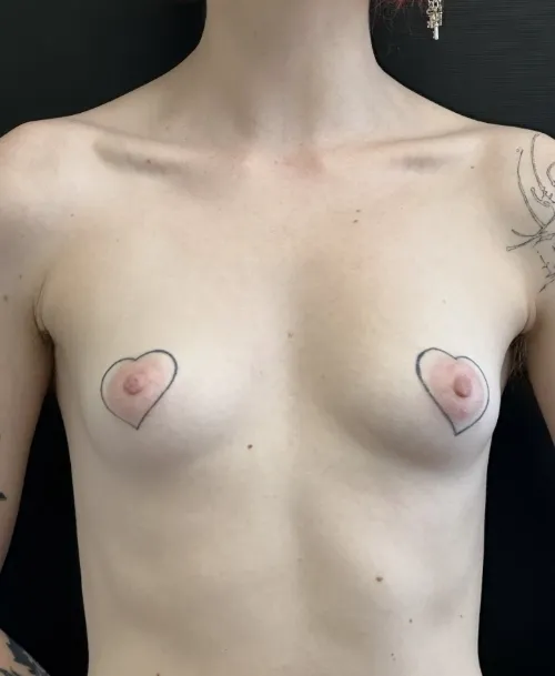 Breast Augmentation before — Breast Augmentation, view 1