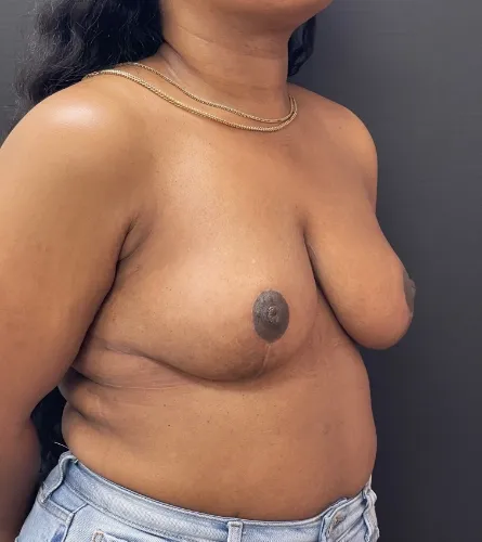 Breast Reduction after — Breast Reduction, view 3