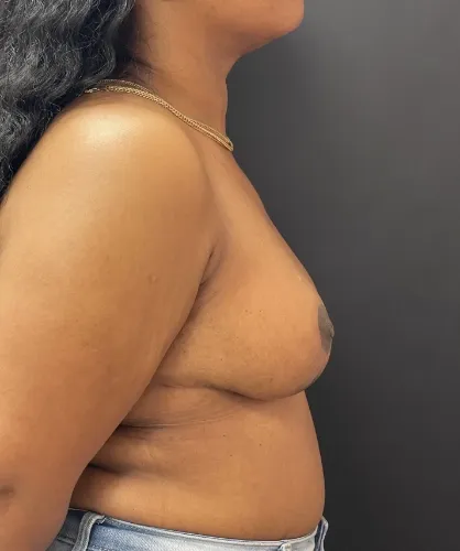 Breast Reduction after — Breast Reduction, view 2