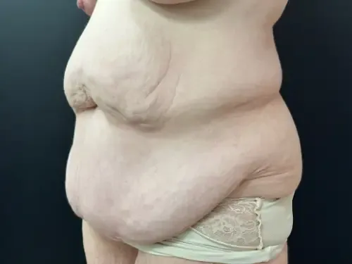 Tummy Tuck and Liposuction before — Tummy Tuck and Liposuction, view 2