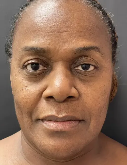 Laser Skin Resurfacing before — Laser Resurfacing, view 1