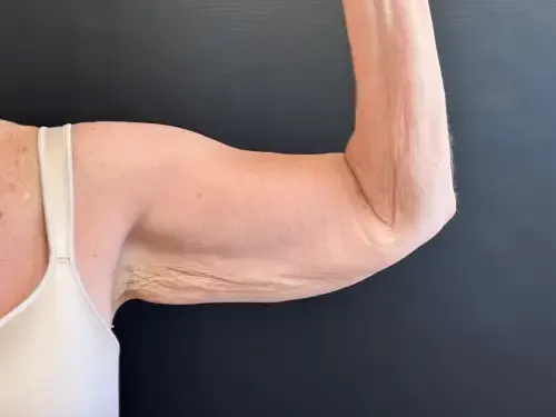 Arm Lift before — Arm Lift, view 1