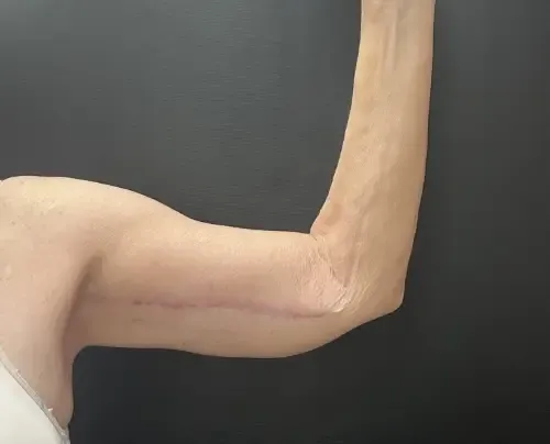 Arm Lift after — Arm Lift, view 1