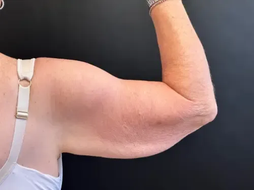 Arm Lift before — Arm Lift, view 2