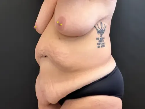 Surgery After Weight Loss before — Surgery After Weight Loss, view 2