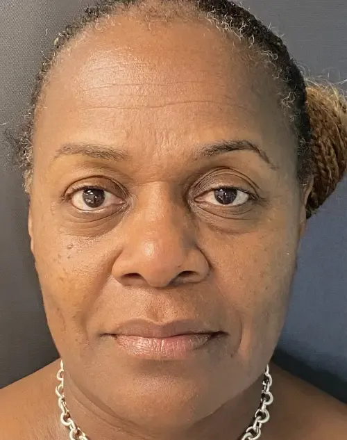 Laser Skin Resurfacing after — Laser Resurfacing, view 1