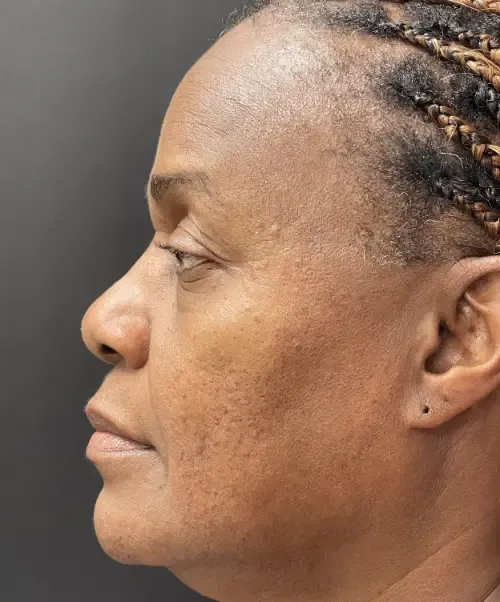 Laser Skin Resurfacing before — Laser Resurfacing, view 3