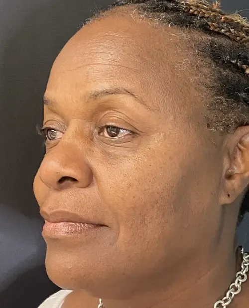 Laser Skin Resurfacing after — Laser Resurfacing, view 2