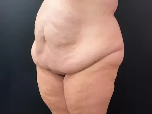 Surgery After Weight Loss before — Surgery After Weight Loss, view 2