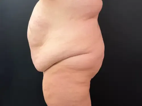 Surgery After Weight Loss before — Surgery After Weight Loss, view 3