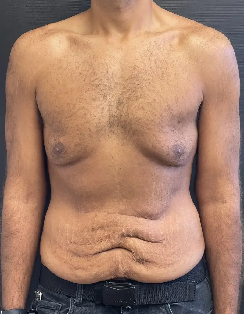Surgery After Weight Loss before — Surgery After Weight Loss, view 1