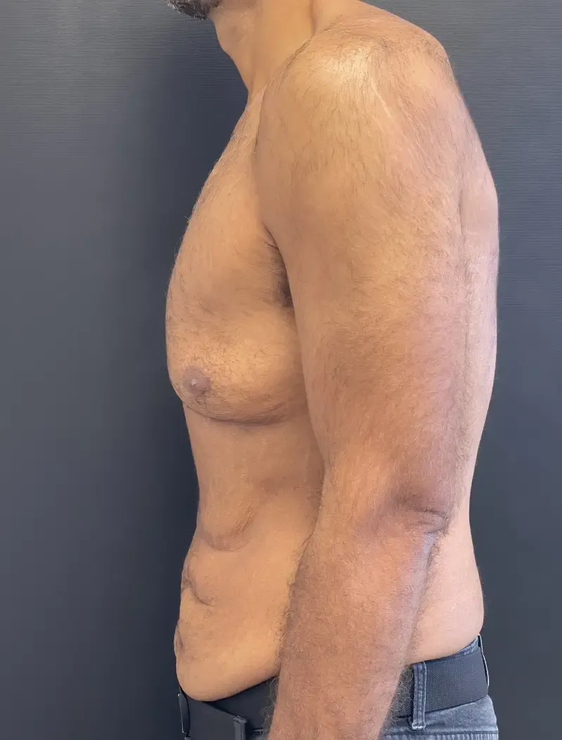 Surgery After Weight Loss before — Surgery After Weight Loss, view 3