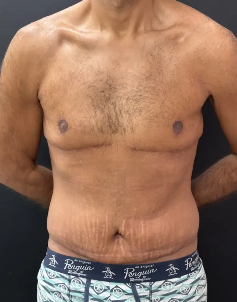 Surgery After Weight Loss after — Surgery After Weight Loss, view 1