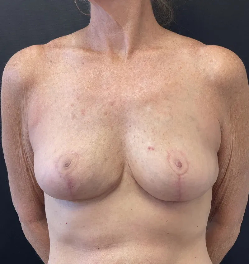 Breast Implant Removal after — Breast Implant Removal and Breast Lift, view 1