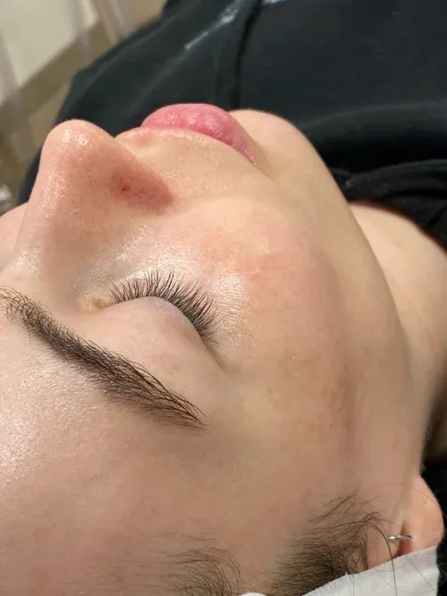 Diamond Glow and Microneedling after — Diamond Glow and Micro Needling Treatment, view 2