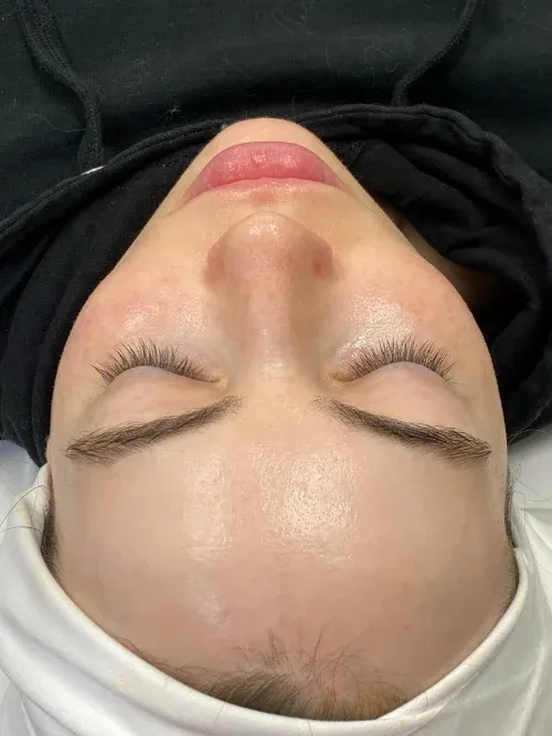 Diamond Glow and Microneedling after — Diamond Glow and Micro Needling Treatment, view 1