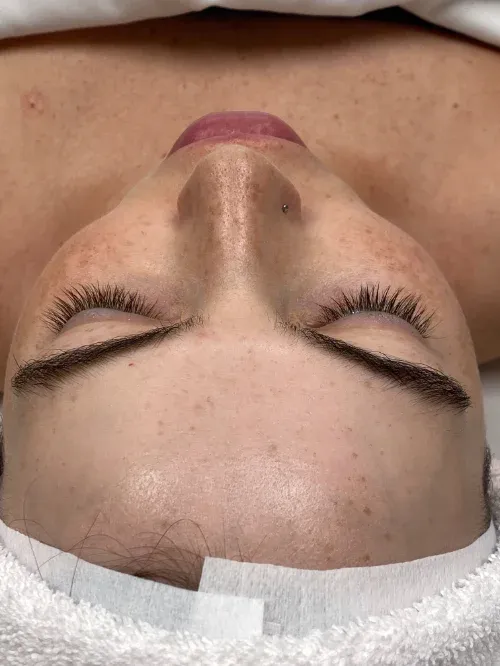 Diamond Glow and Microneedling before — Diamond Glow and Micro Needling Treatment, view 1