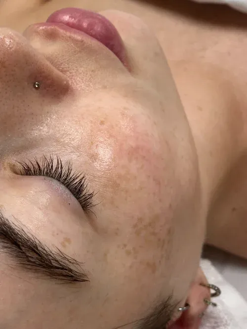 Diamond Glow and Microneedling before — Diamond Glow and Micro Needling Treatment, view 2