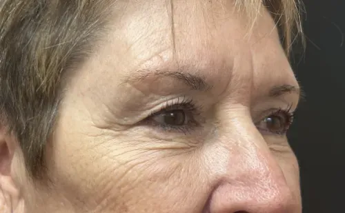 Blepharoplasty before — Upper Blepharoplasty