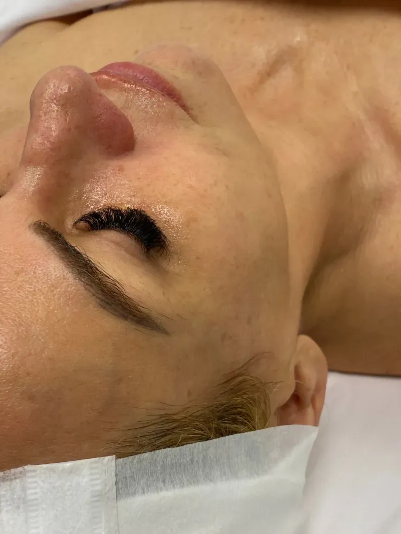 Diamond Glow and Microneedling after — Diamond Glow, view 1