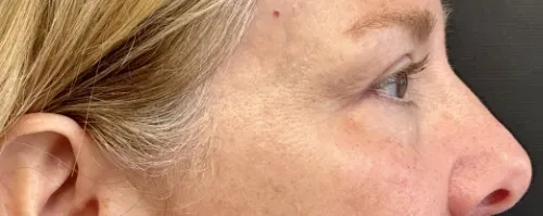 Blepharoplasty after — Upper Blepharoplasty
