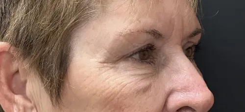 Blepharoplasty after — Upper Blepharoplasty