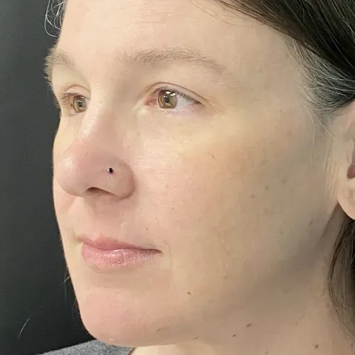 Blepharoplasty after — Upper Blepharoplasty