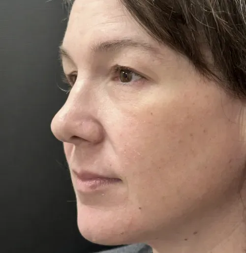 Blepharoplasty before — Upper Blepharoplasty