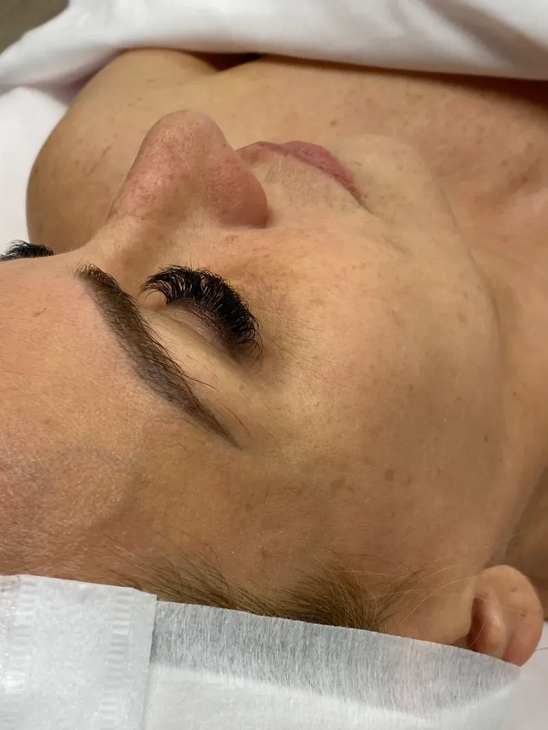 Diamond Glow and Microneedling before — Diamond Glow, view 1