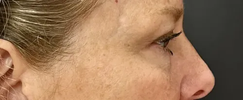 Blepharoplasty before — Upper Blepharoplasty