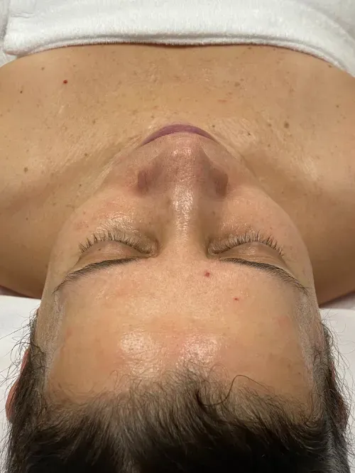 Diamond Glow and Microneedling after — Diamond Glow, view 1