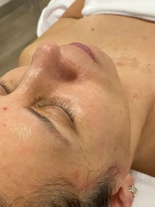 Diamond Glow and Microneedling after — Diamond Glow, view 2