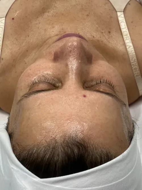 Diamond Glow and Microneedling before — Diamond Glow, view 1