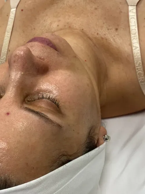Diamond Glow and Microneedling before — Diamond Glow, view 2