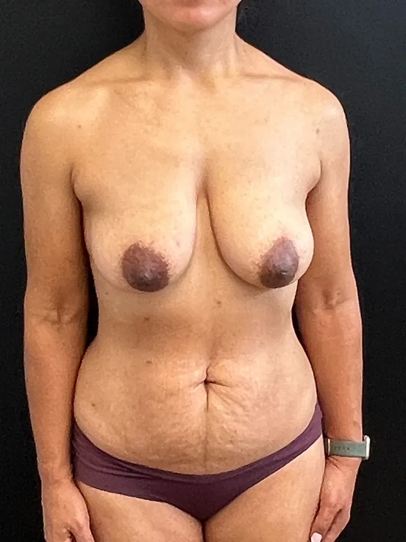 Mommy Makeover before — Mommy Makeover: Breast Lift and Tummy Tuck