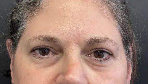 Blepharoplasty after — Upper Blepharoplasty