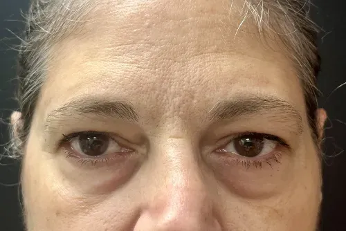 Blepharoplasty before — Upper Blepharoplasty