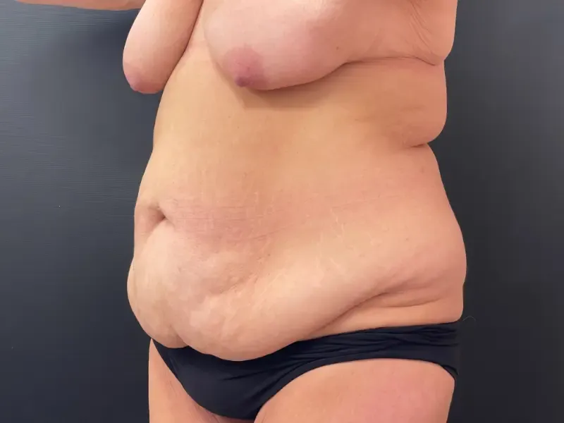 Mommy Makeover before — Mommy Makeover: Breast Lift with 310cc Augmentation and Tummy Tuck, view 2