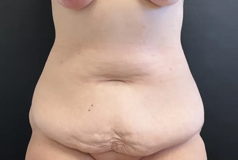 Tummy Tuck and Liposuction before — Tummy Tuck